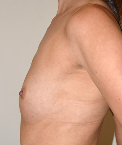 Breast Augmentation Before and After 45