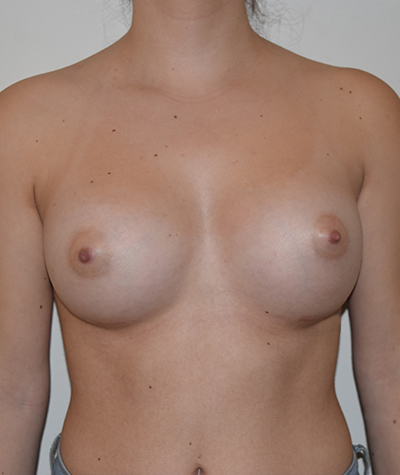 Breast Augmentation Before and After 31