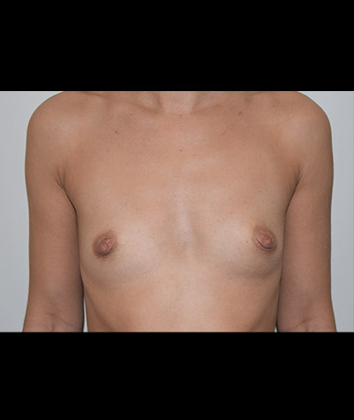 Breast Augmentation Before and After 48