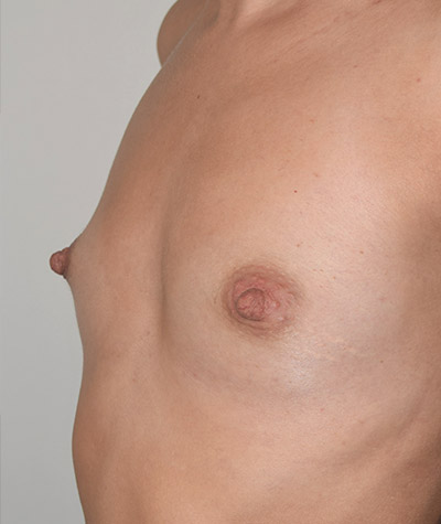 Breast Augmentation Before and After 48