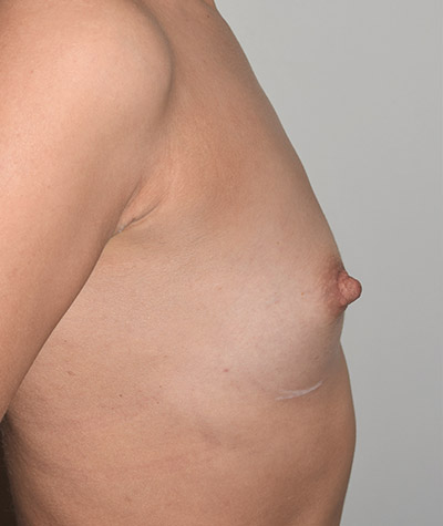 Breast Augmentation Before and After 48