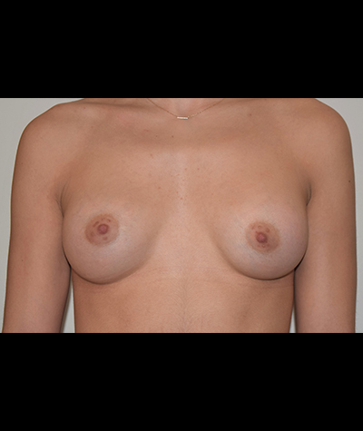 Breast Augmentation Before and After 31
