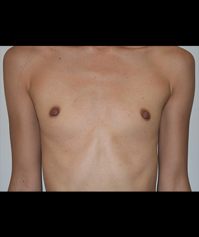 Breast Augmentation Before and After 50