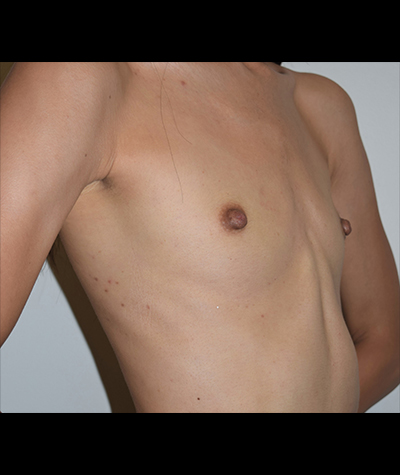 Breast Augmentation Before and After 50