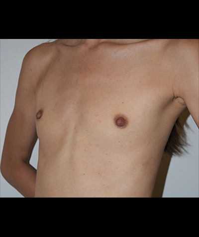 Breast Augmentation Before and After 50