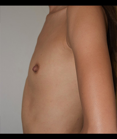 Breast Augmentation Before and After 50