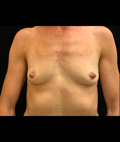 Breast Augmentation Before and After 55
