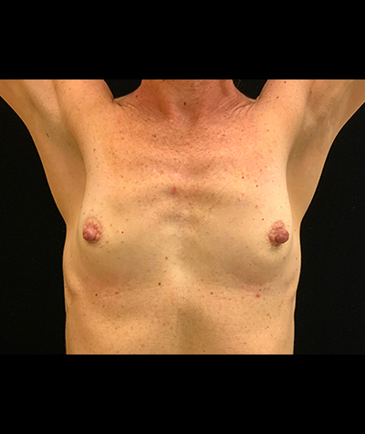 Breast Augmentation Before and After 55