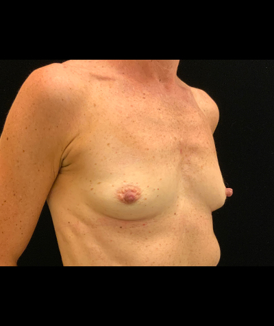 Breast Augmentation Before and After 55