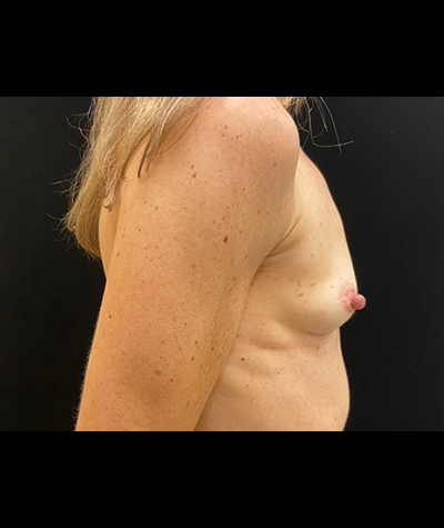 Breast Augmentation Before and After 55